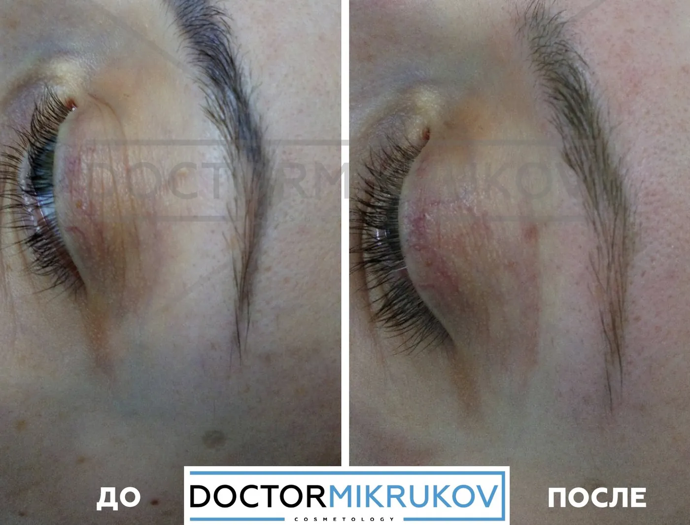 9 фактов о лазерном удалении татуажа и тату, которые не знакомы новичкам! — Факт 4: Полное удаление татуажа и тату возможно без следов на коже, рубцов и шрамов