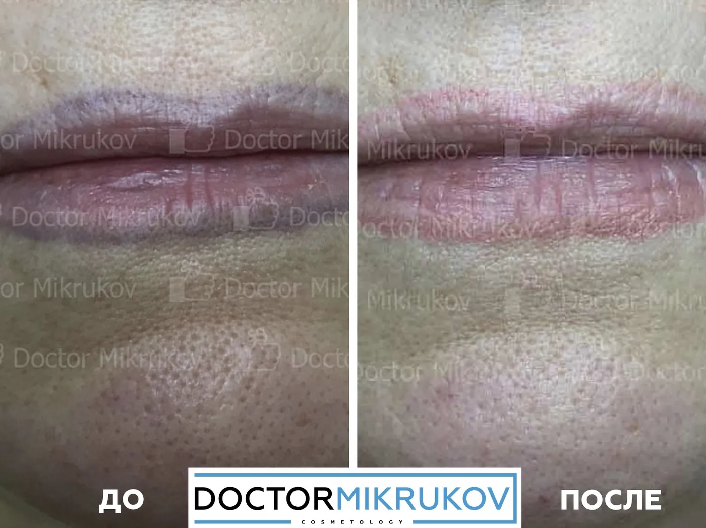 9 фактов о лазерном удалении татуажа и тату, которые не знакомы новичкам! — Факт 4: Полное удаление татуажа и тату возможно без следов на коже, рубцов и шрамов