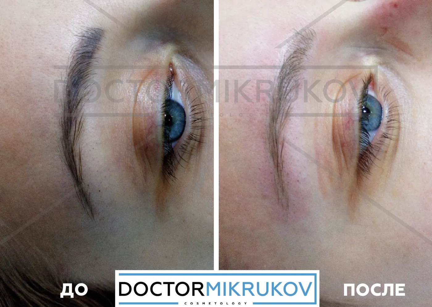9 фактов о лазерном удалении татуажа и тату, которые не знакомы новичкам! — Факт 4: Полное удаление татуажа и тату возможно без следов на коже, рубцов и шрамов