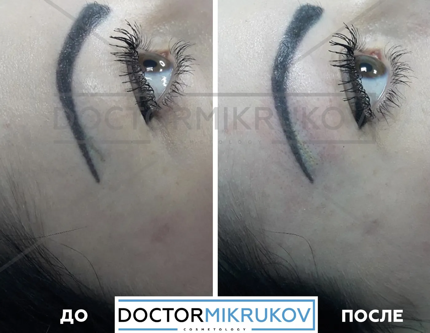 9 фактов о лазерном удалении татуажа и тату, которые не знакомы новичкам! — Факт 4: Полное удаление татуажа и тату возможно без следов на коже, рубцов и шрамов