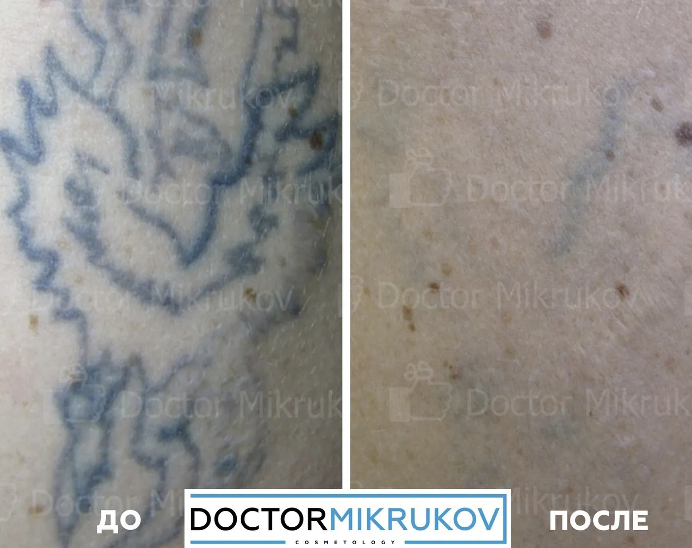 9 фактов о лазерном удалении татуажа и тату, которые не знакомы новичкам! — Факт 4: Полное удаление татуажа и тату возможно без следов на коже, рубцов и шрамов