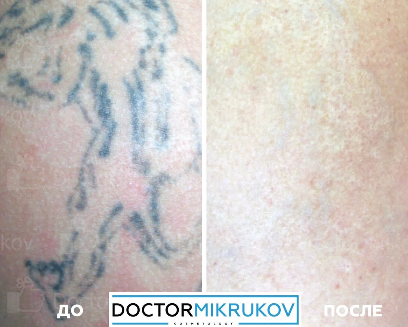 9 фактов о лазерном удалении татуажа и тату, которые не знакомы новичкам! — Факт 4: Полное удаление татуажа и тату возможно без следов на коже, рубцов и шрамов