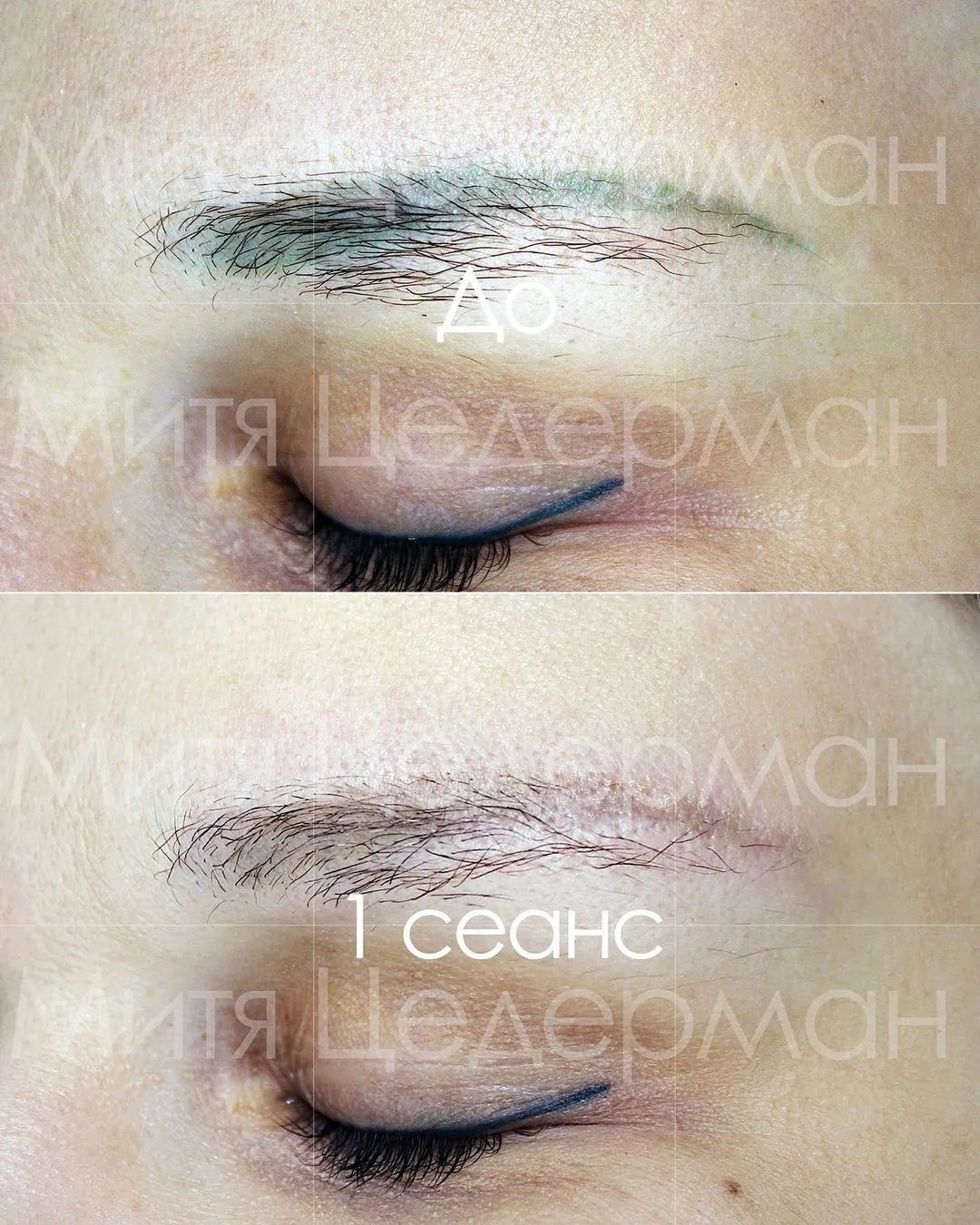 Как удалить зелёный татуаж бровей?