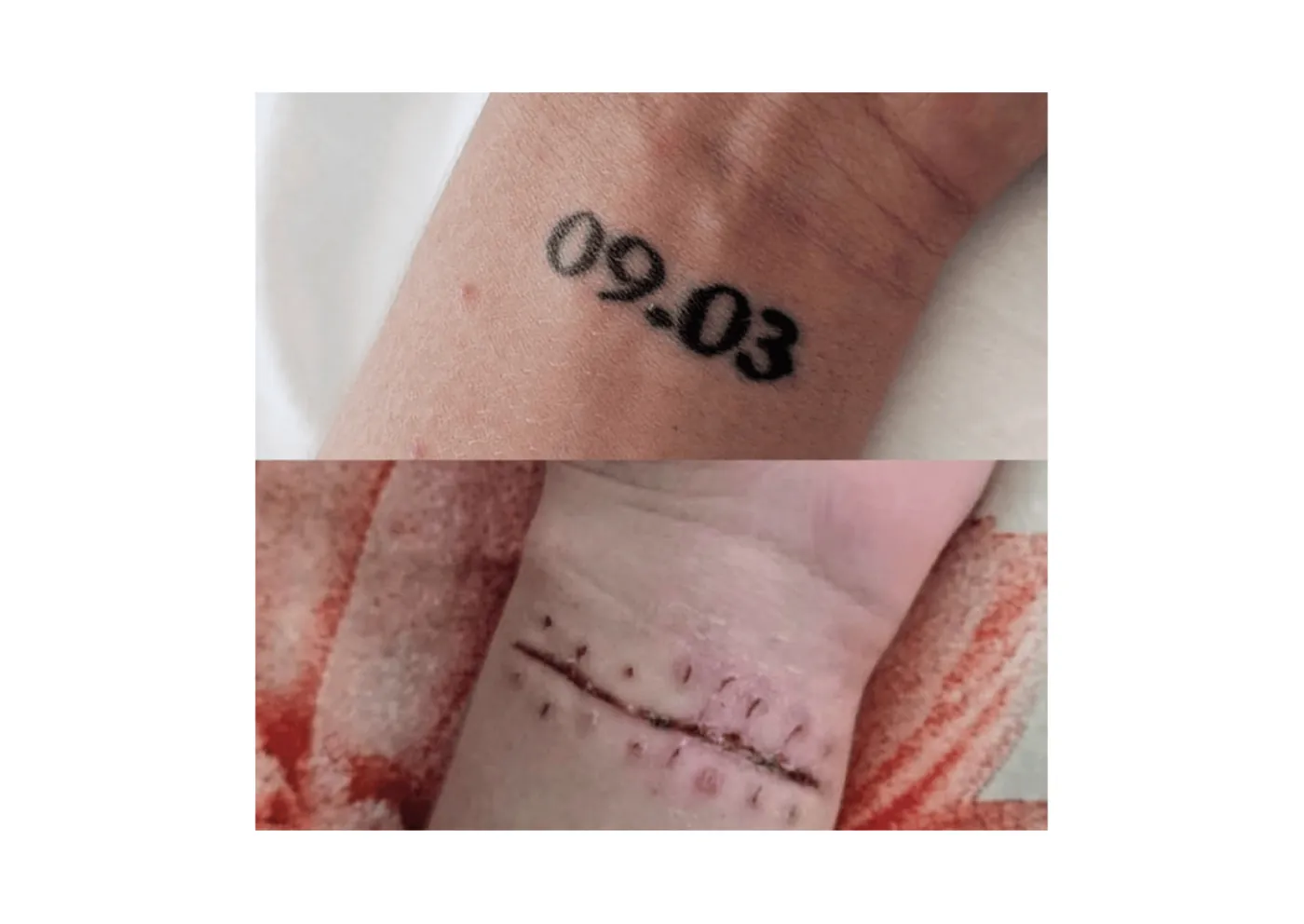 Surgical excision: removing a tattoo or PMU in one session