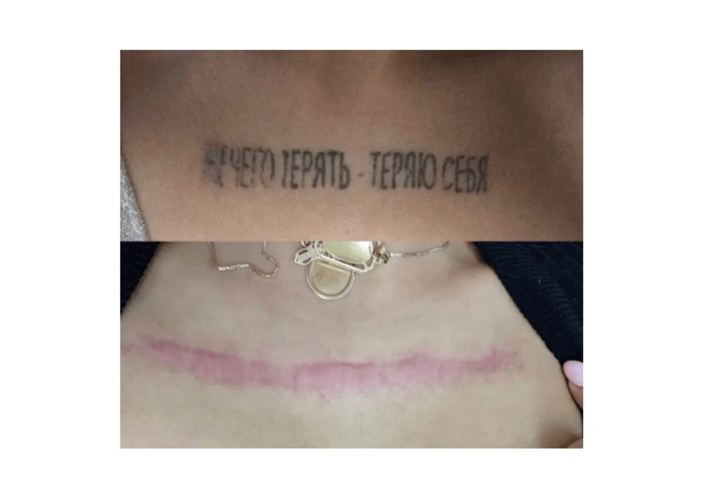 Surgical excision: removing a tattoo or PMU in one session