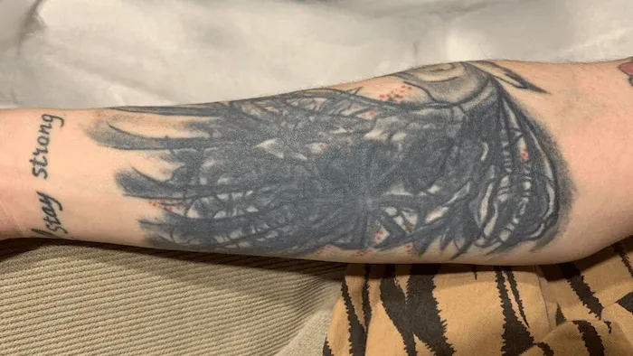 Tato hitam bertumpuk di lengan bawah bagian dalam sebelum dilaser