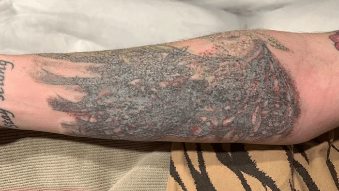 Kulit tepat setelah hapus tato laser dengan spot kecil