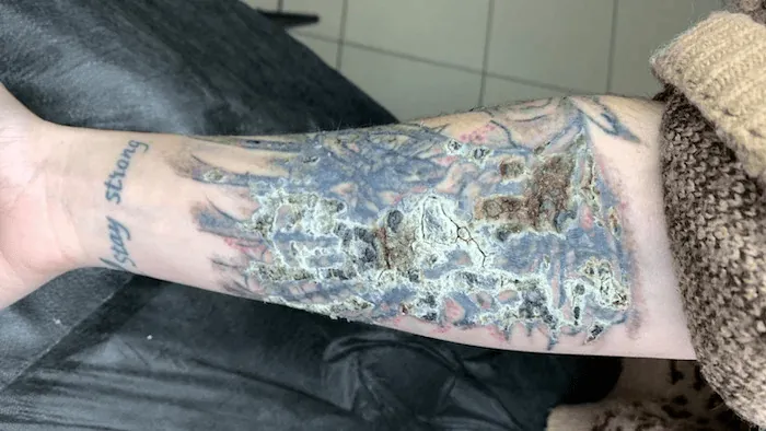 Komplikasi setelah hapus tato laser