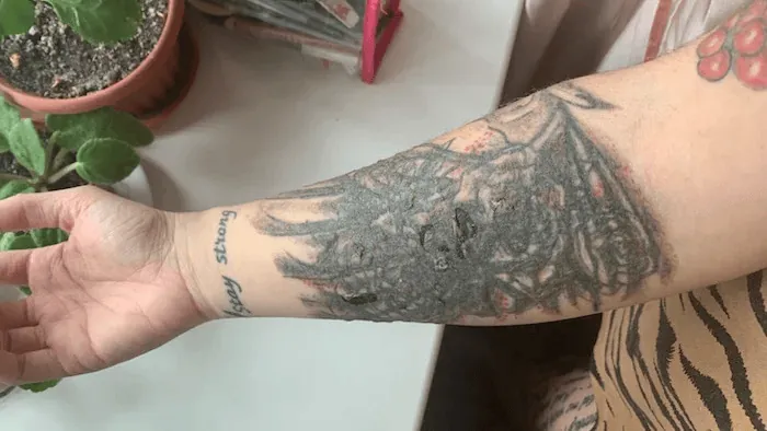 Lepuh setelah hapus tato laser