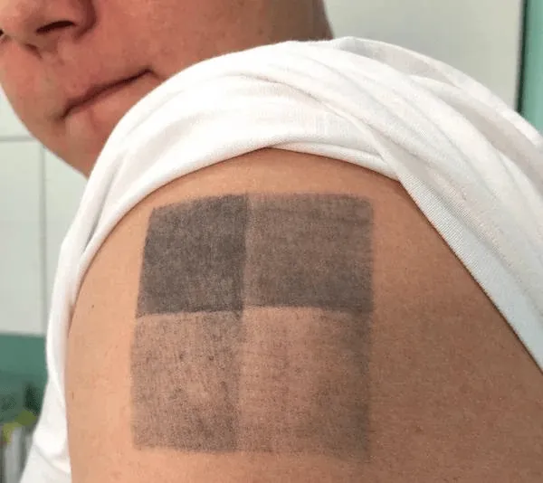 Hapus tato laser pada diri sendiri: eksperimen pribadi saya