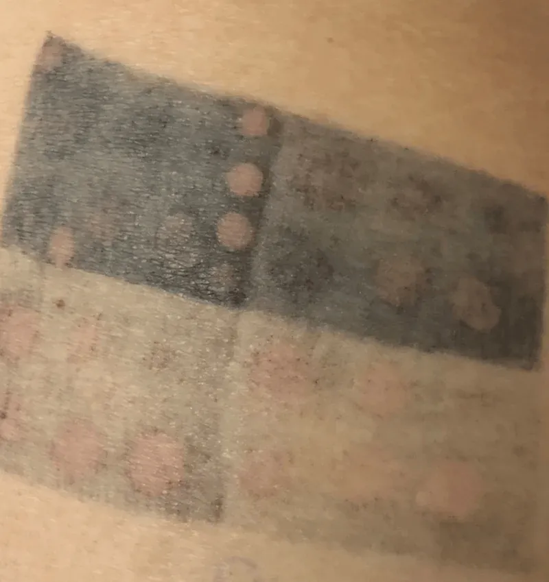 Hapus tato laser pada diri sendiri: eksperimen pribadi saya — Sesi hapus tato laser pertama