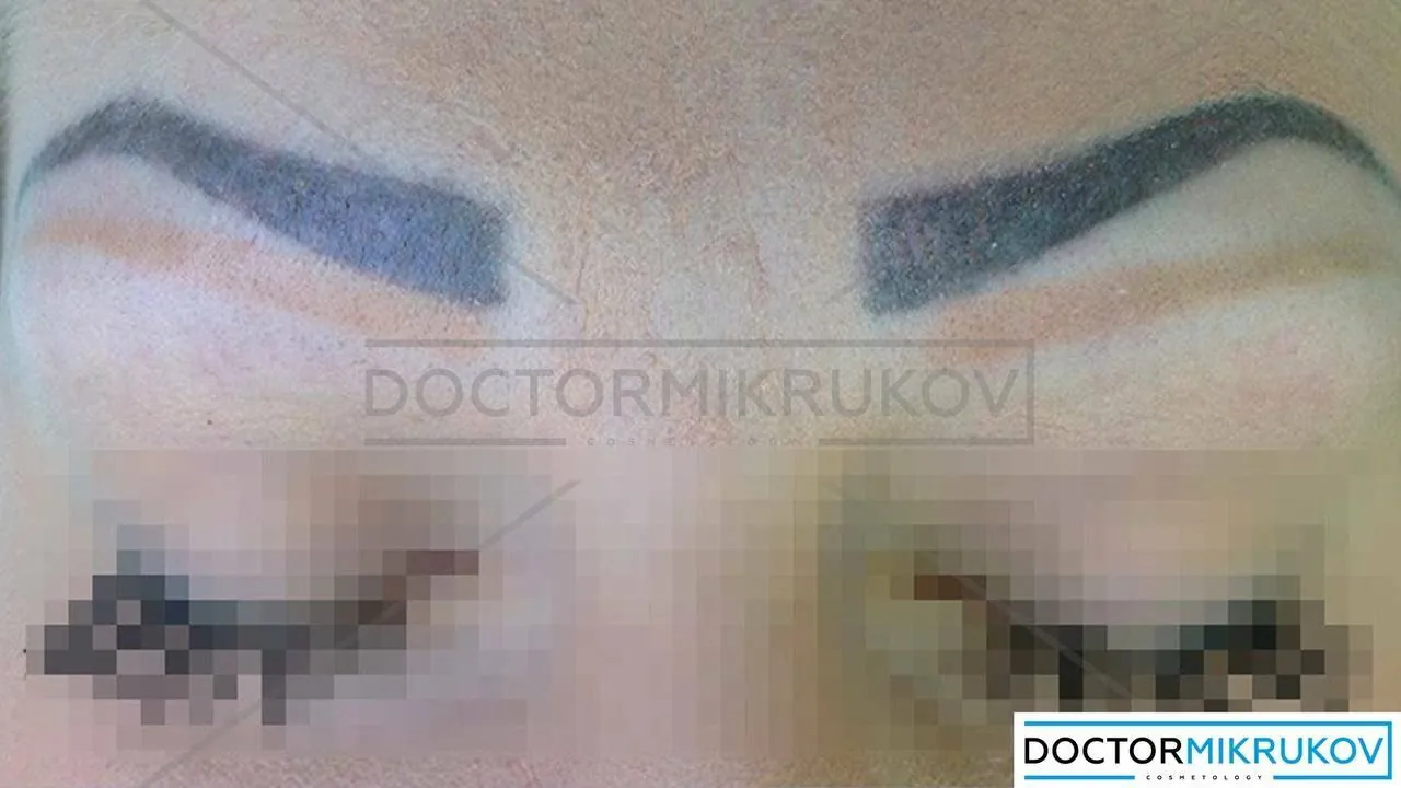 Можно ли легко и быстро заработать на лазерном удалении татуажа и тату? — Нет уверенности в себе, удар по репутации