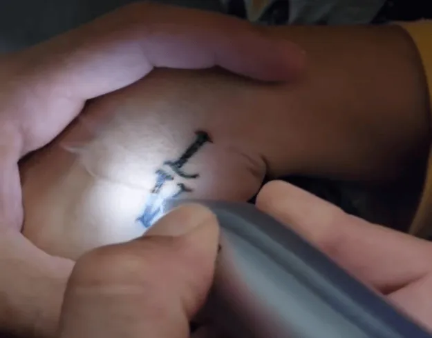 Plasma pen na maloj crnoj tetovaži na zapešću