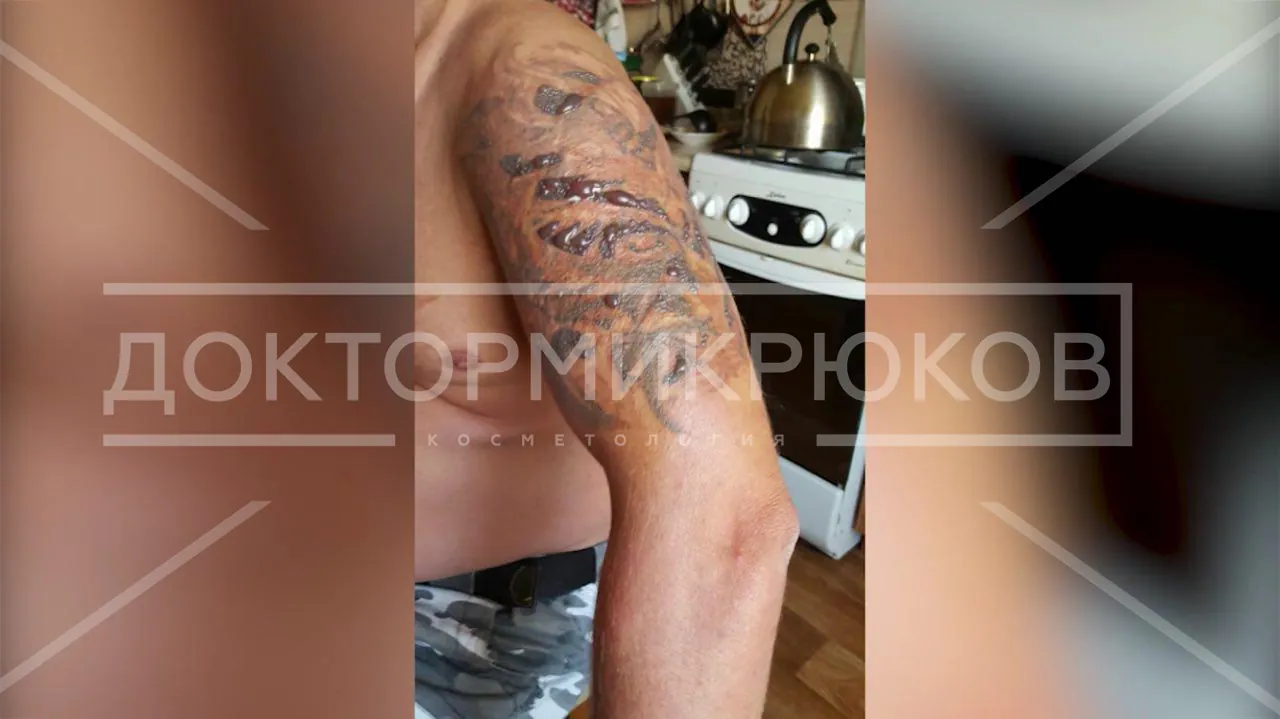 Почему при удалении тату и татуажа лазером бывают осложнения?
