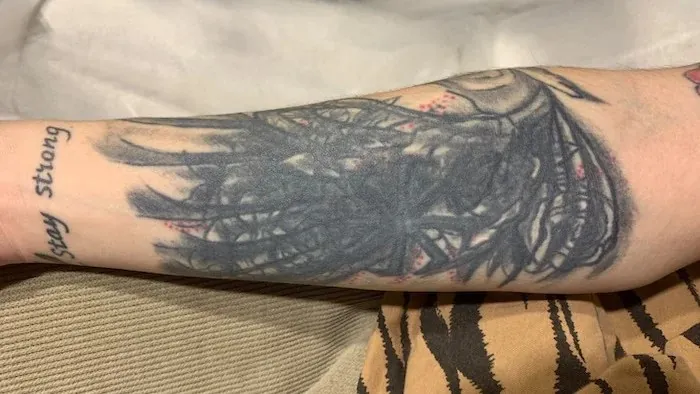 удаление тату лазером осложнения