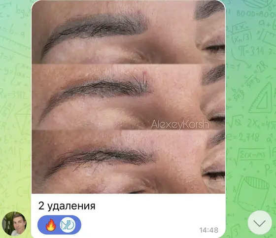 Брови после двух удалений
